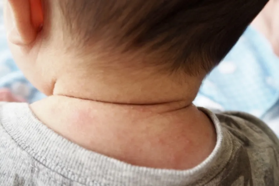 Sudamina [Sweat Rash]